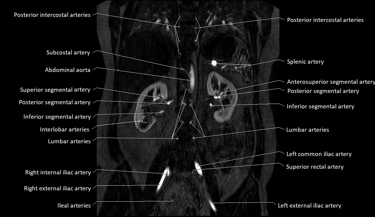 MRA Abdomen coronal anatomy image 29.webp
